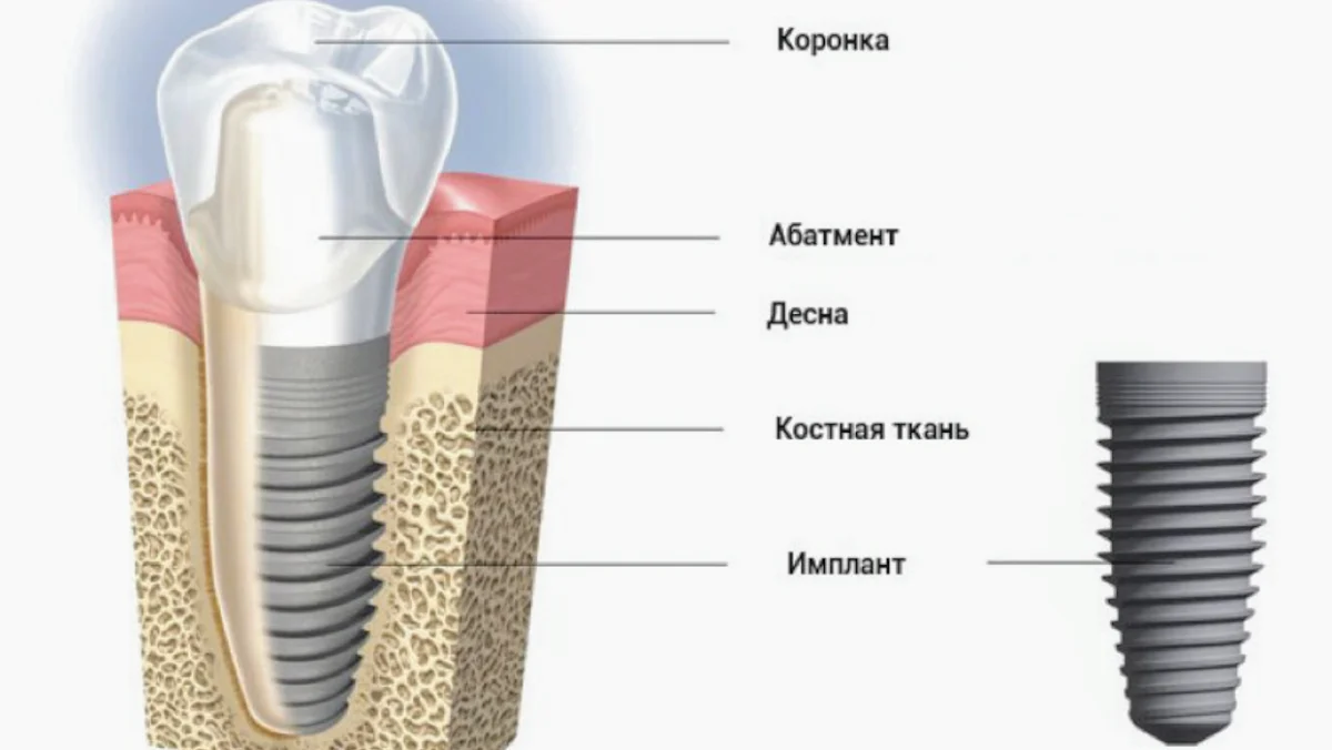 Клиника дентальной имплантации - 2