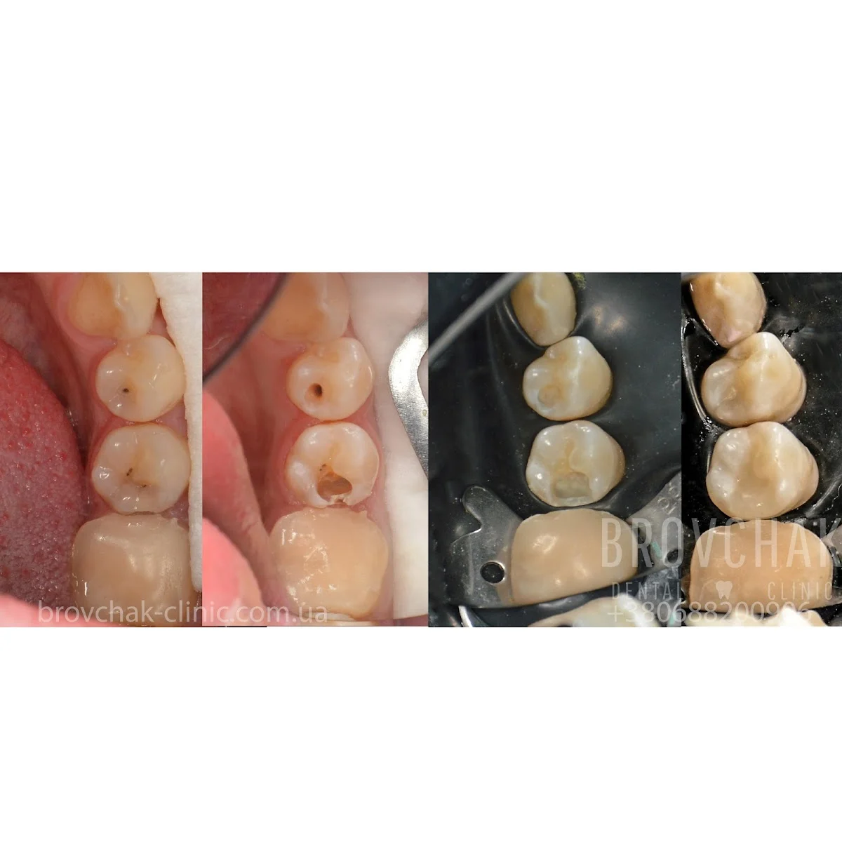 Стоматологія на Голосієвській Brovchak Dental. Лікування зубів під мікроскопом Київ.. - 2