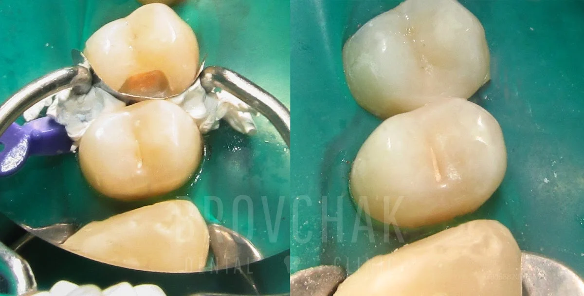 Стоматологія на Голосієвській Brovchak Dental. Лікування зубів під мікроскопом Київ.. - 4
