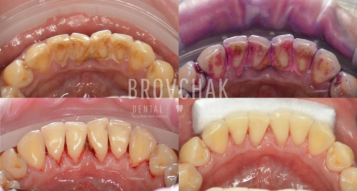 Стоматологія на Голосієвській Brovchak Dental. Лікування зубів під мікроскопом Київ..