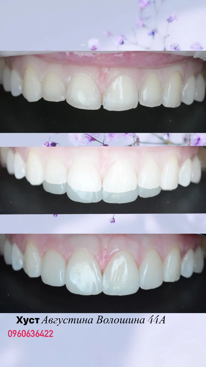 Esthetic smile - 2